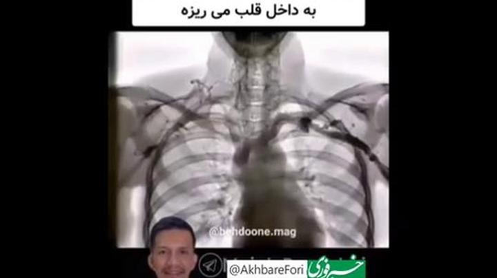 ♦️با این سه حرکت با سکته قلبی خداحافظی کن!